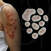 Cigarette Burn Scars Bondo Set