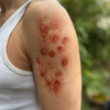 Cigarette Burn Scars Bondo Set