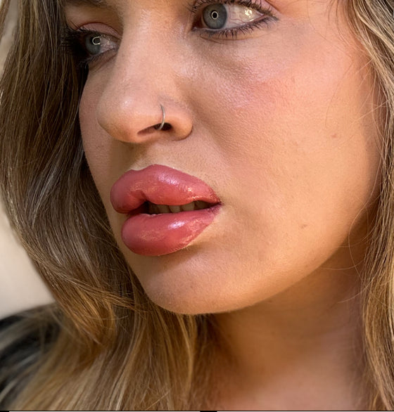 The Botched Lip Filler