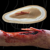 The Compound Fracture