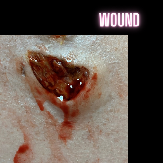 Skin Wound 1