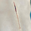 Person with a visible surgical scar on their back