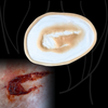 Skin Wound 5