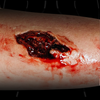 Skin Wound 2