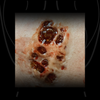 Skin Disease Wound 1